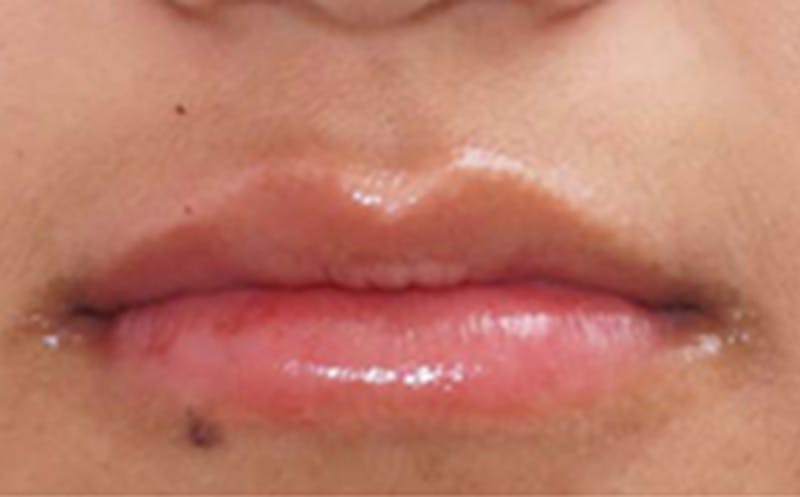 Fillers Before & After Gallery - Patient 248678 - Image 2