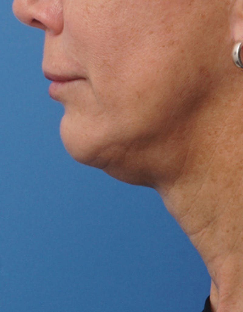 Chin Surgery Before & After Gallery - Patient 229983 - Image 3
