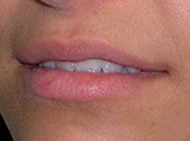 Lip Fillers Before & After Gallery - Patient 210907 - Image 3