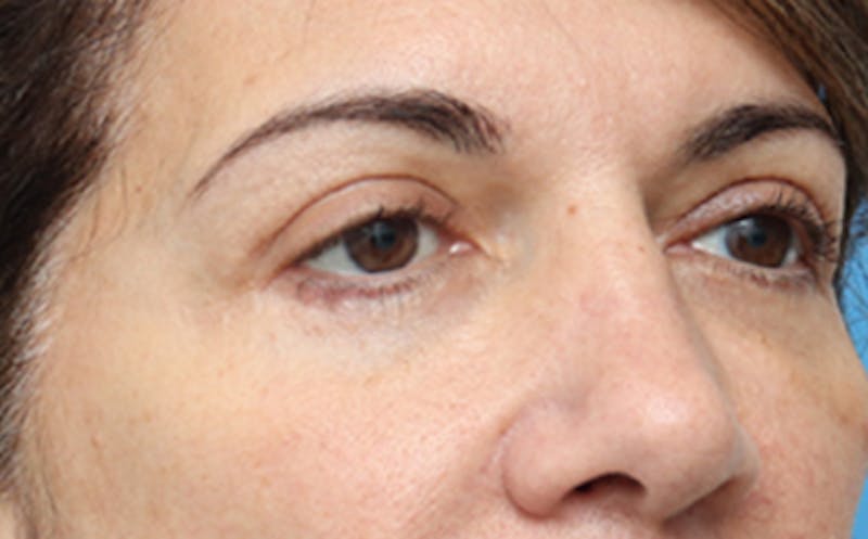 Eyelid Surgery Before & After Gallery - Patient 7334 - Image 4