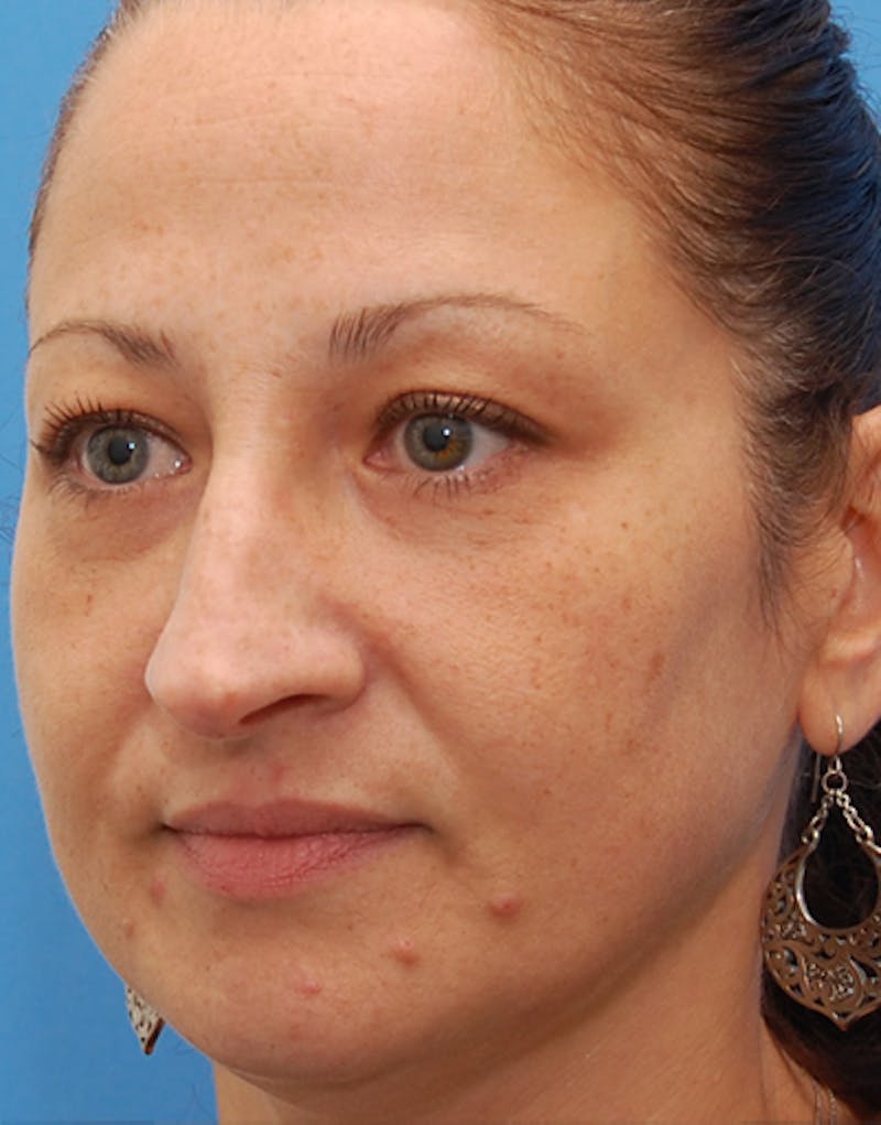 Rhinoplasty  Before & After Gallery - Patient 167433 - Image 7