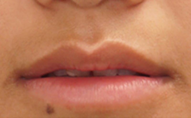 Fillers Before & After Gallery - Patient 248678 - Image 3