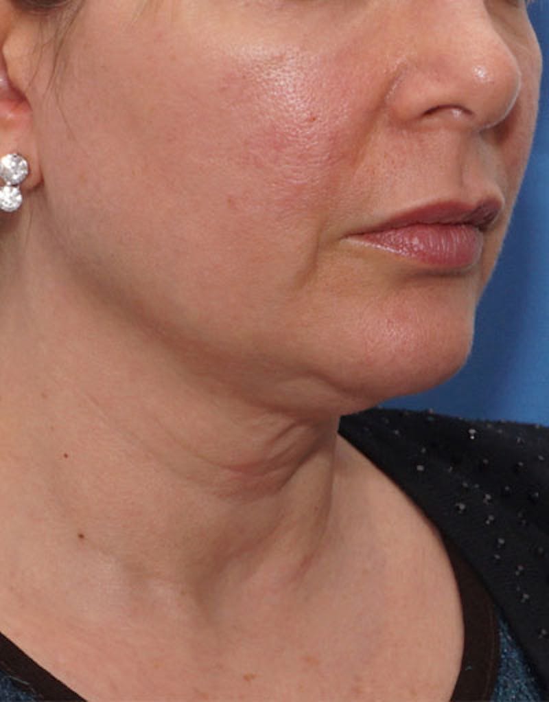 FaceTite Before & After Gallery - Patient 180927 - Image 3