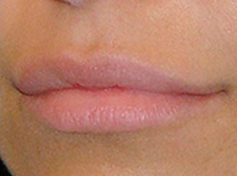 Lip Fillers Before & After Gallery - Patient 210907 - Image 4