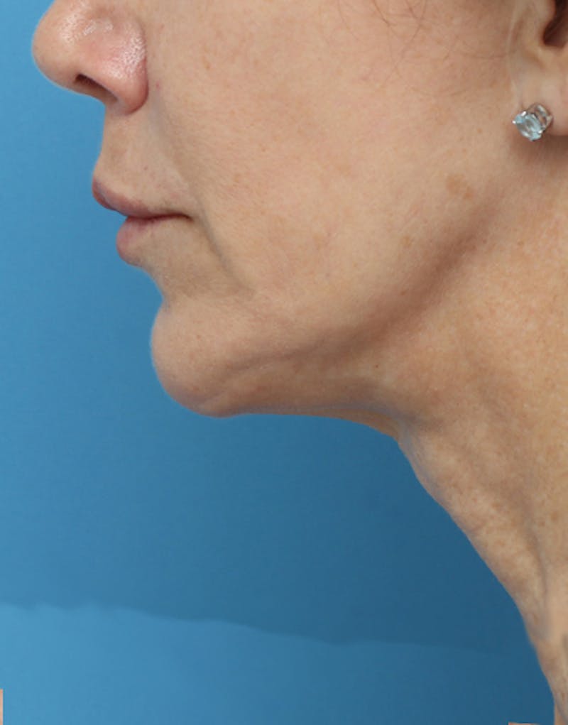 Chin Surgery Before & After Gallery - Patient 229983 - Image 4