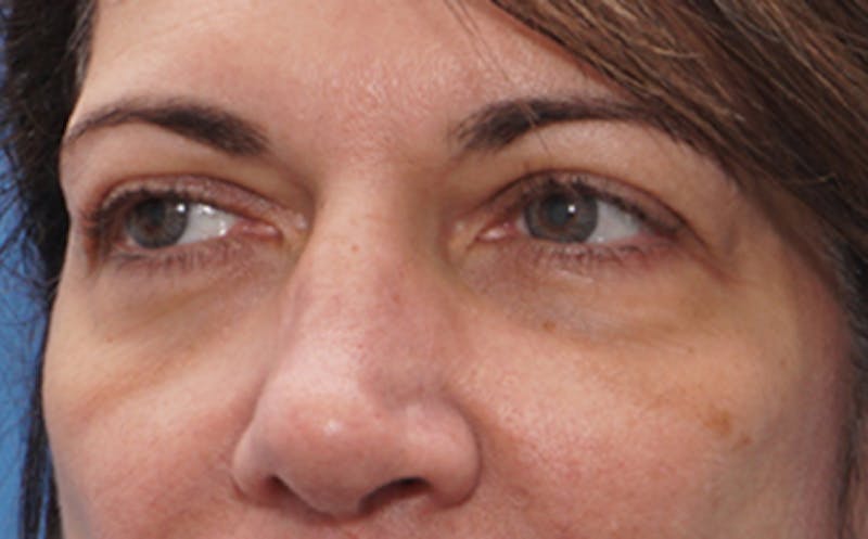 Eyelid Surgery Before & After Gallery - Patient 7334 - Image 5