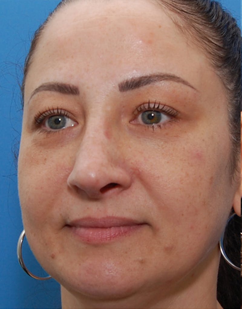 Rhinoplasty  Before & After Gallery - Patient 167433 - Image 8