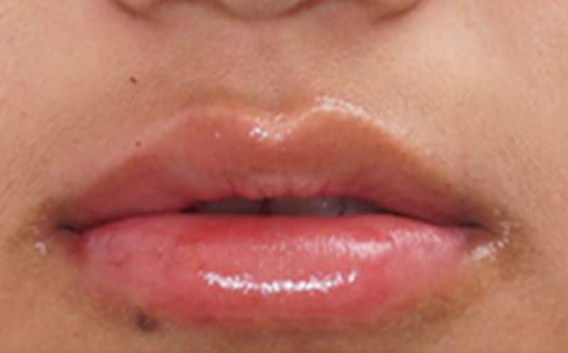 Fillers Before & After Gallery - Patient 248678 - Image 4