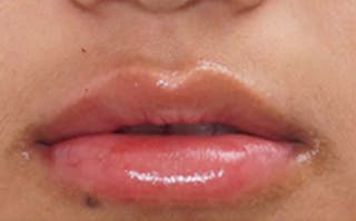 Fillers Before & After Gallery - Patient 248678 - Image 4