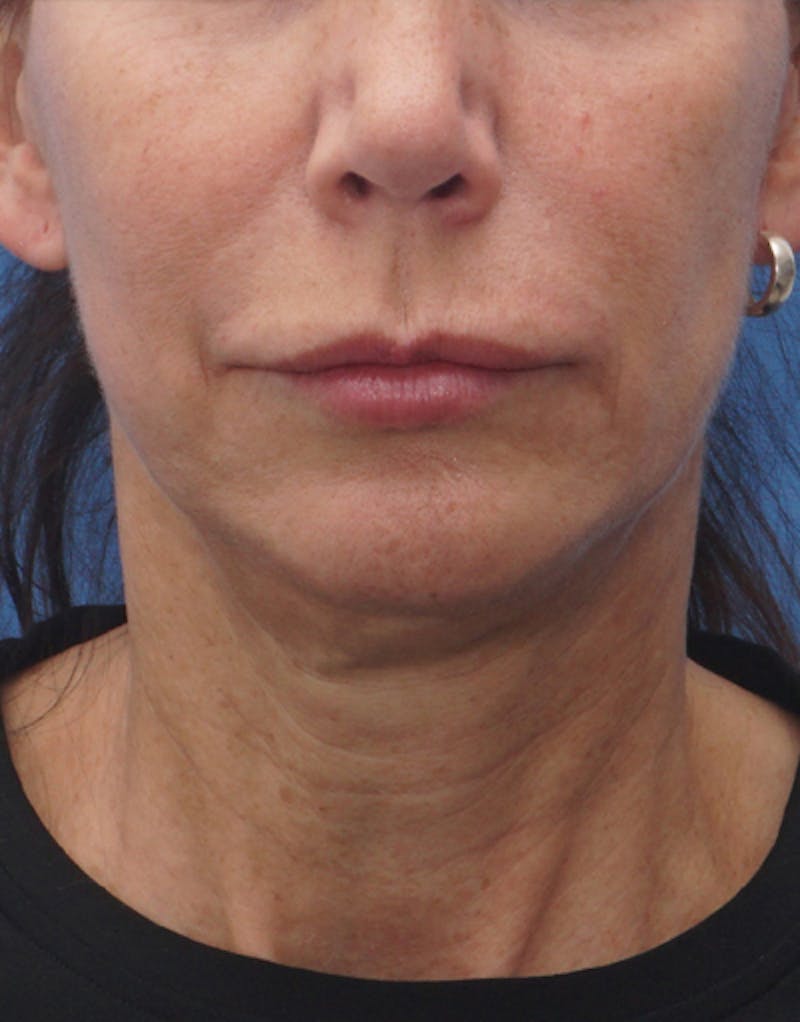 Chin Surgery Before & After Gallery - Patient 229983 - Image 5