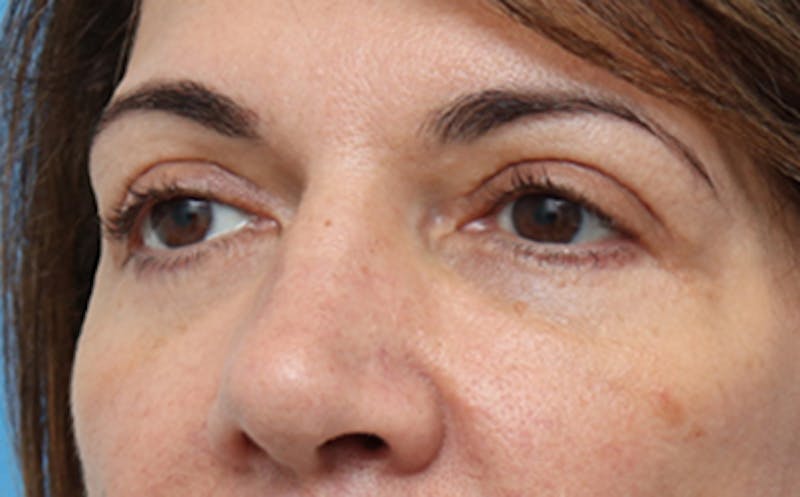 Eyelid Surgery Before & After Gallery - Patient 7334 - Image 6