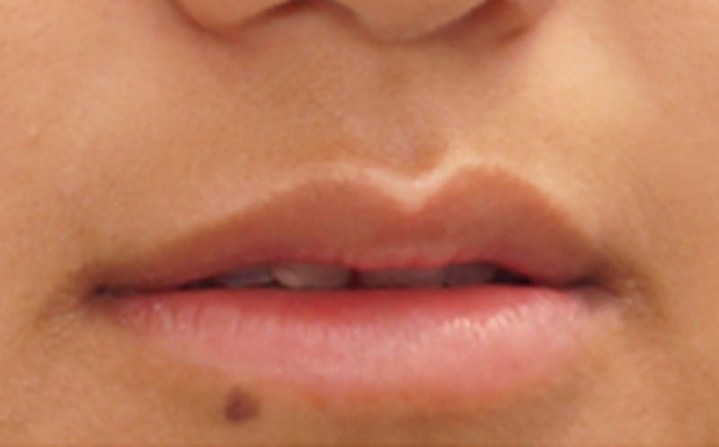 Fillers Before & After Gallery - Patient 248678 - Image 5