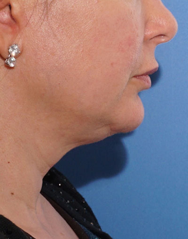 FaceTite Before & After Gallery - Patient 180927 - Image 5