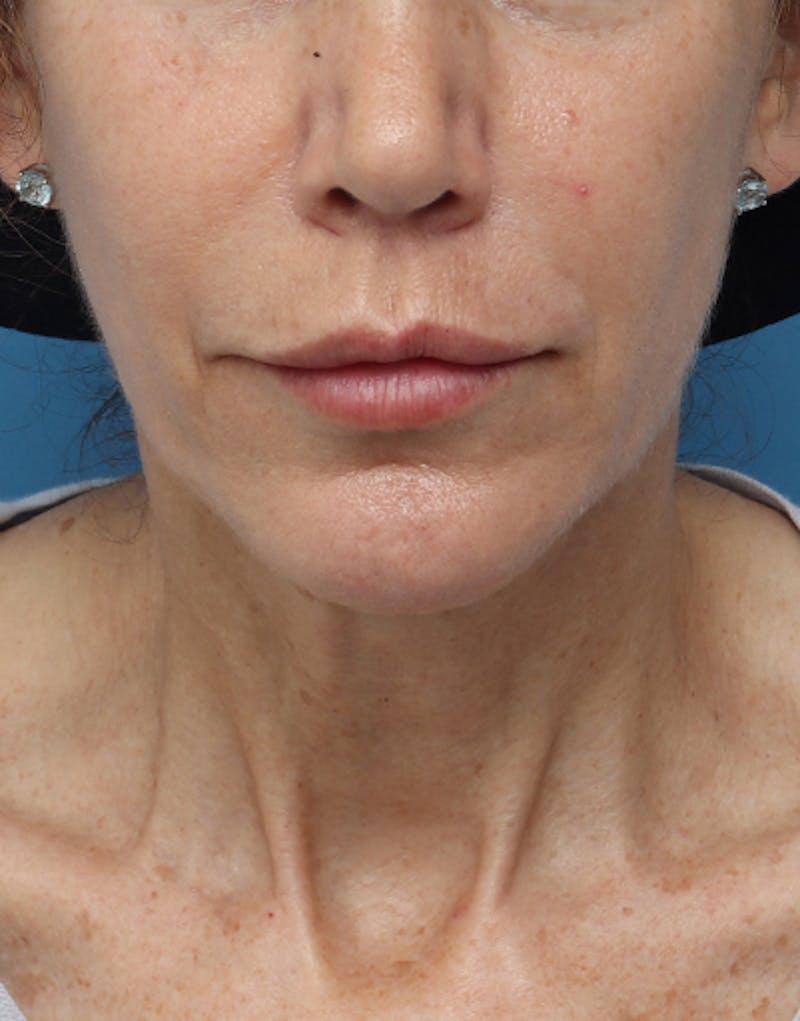 Chin Surgery Before & After Gallery - Patient 229983 - Image 6