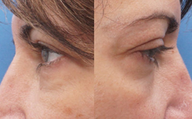 Eyelid Surgery Before & After Gallery - Patient 7334 - Image 7