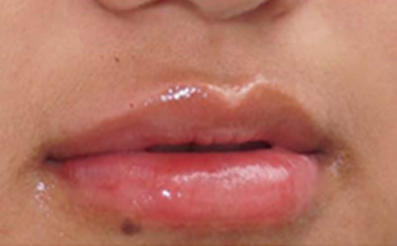 Fillers Before & After Gallery - Patient 248678 - Image 6
