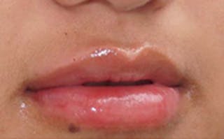 Fillers Before & After Gallery - Patient 248678 - Image 6