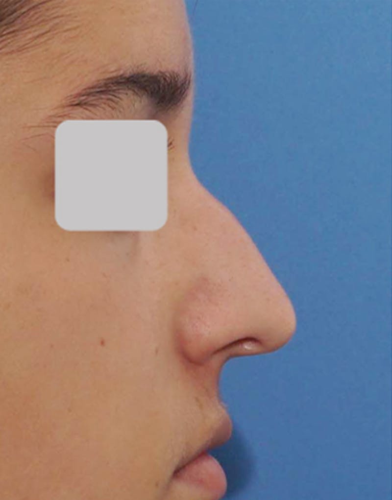 Rhinoplasty Before & After Gallery - Patient 125769 - Image 1