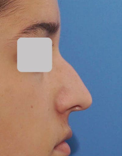 Rhinoplasty Before & After Gallery - Patient 215853 - Image 1