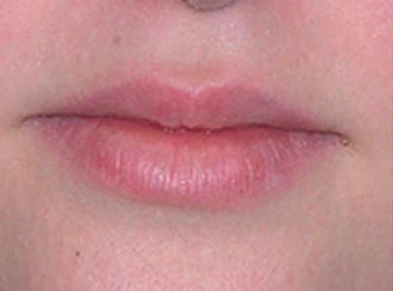 Lip Fillers Before & After Gallery - Patient 116113 - Image 1