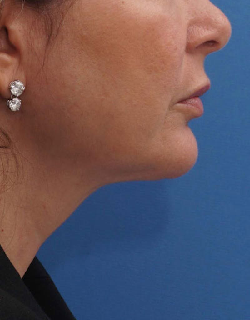 FaceTite Before & After Gallery - Patient 180927 - Image 8