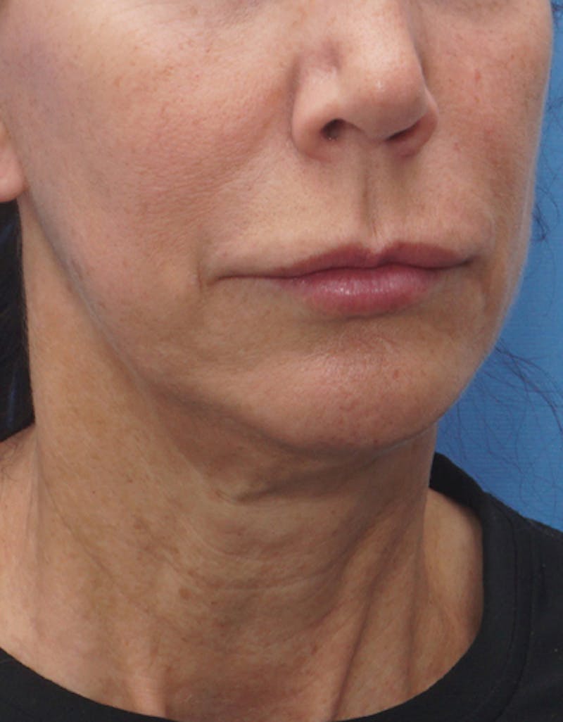 Chin Surgery Before & After Gallery - Patient 229983 - Image 7