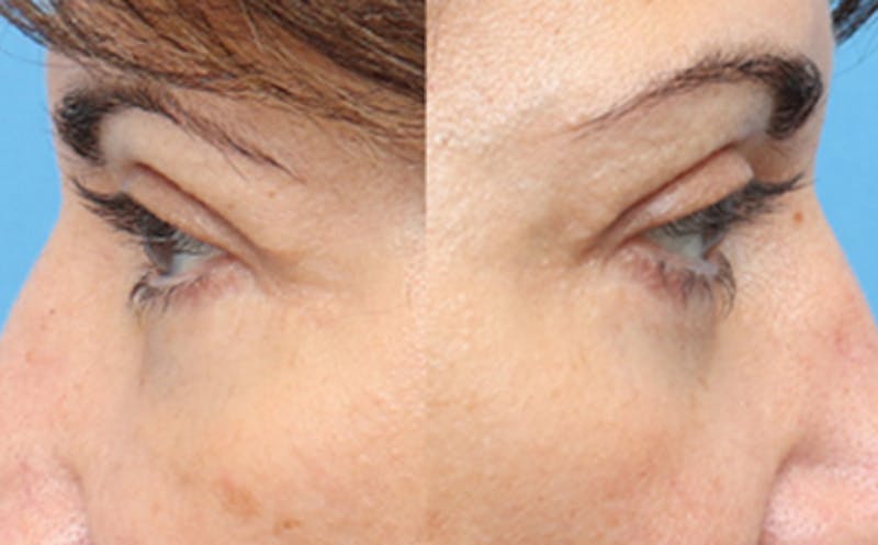 Eyelid Surgery Before & After Gallery - Patient 7334 - Image 8