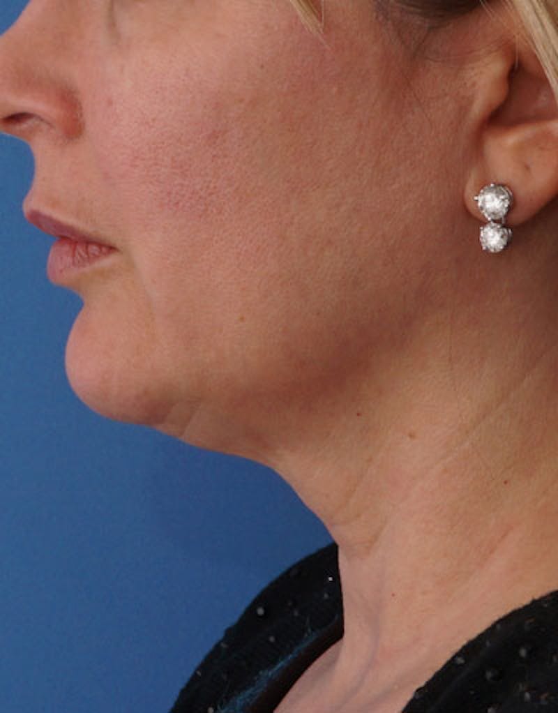 Patient ChEvEvAjRKebkUd-KAbzaw - FaceTite Before & After Photos
