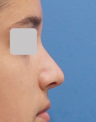 Rhinoplasty Before & After Gallery - Patient 215853 - Image 2