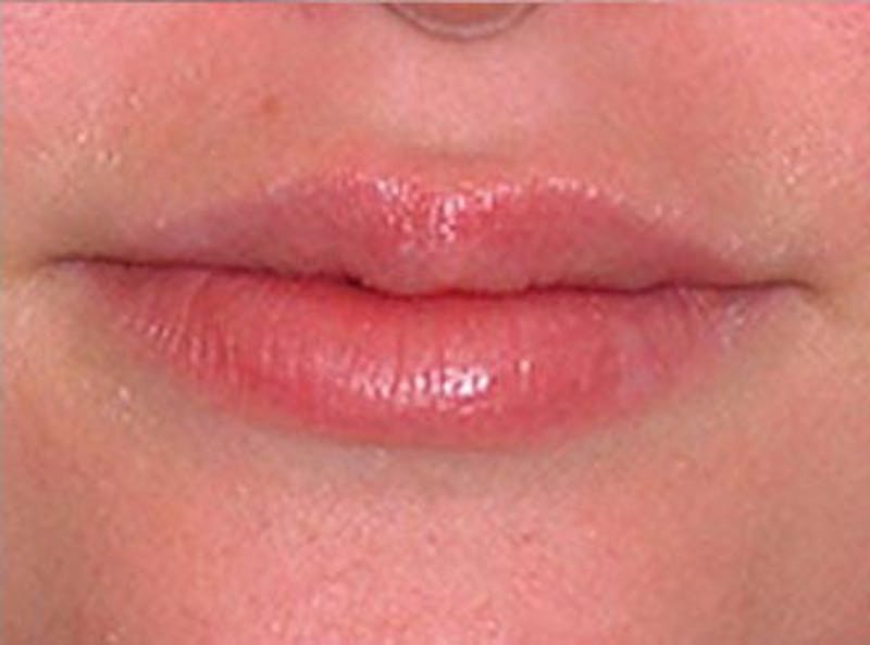 Lip Fillers Before & After Gallery - Patient 116113 - Image 2