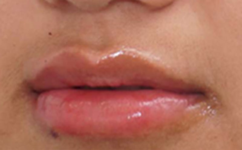 Fillers Before & After Gallery - Patient 248678 - Image 8