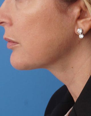 FaceTite Before & After Gallery - Patient 180927 - Image 2