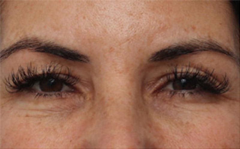 Eyelid Surgery Before & After Gallery - Patient 298444 - Image 1