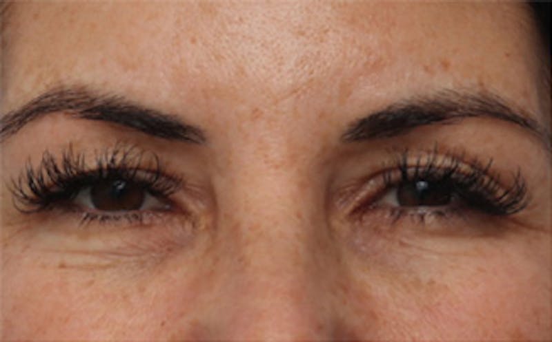 Eyelid Surgery Before & After Gallery - Patient 298444 - Image 5