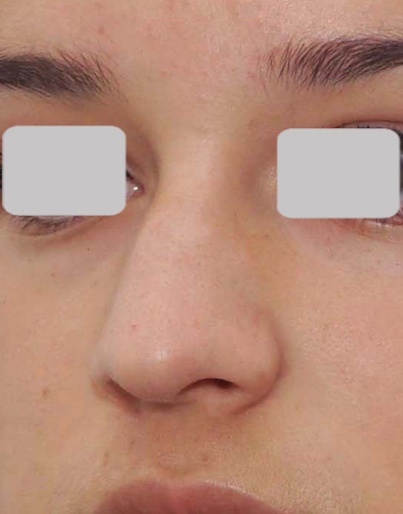 Rhinoplasty  Before & After Gallery - Patient 215853 - Image 3