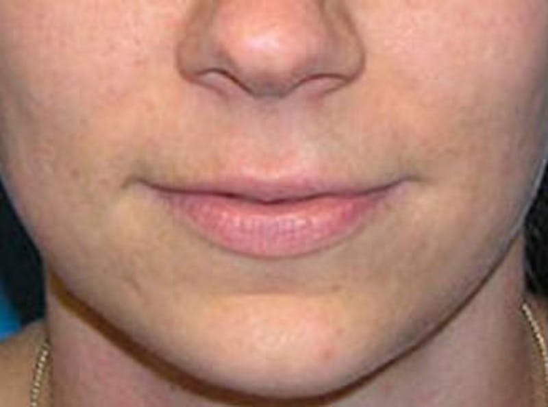 Lip Fillers Before & After Gallery - Patient 132953 - Image 1