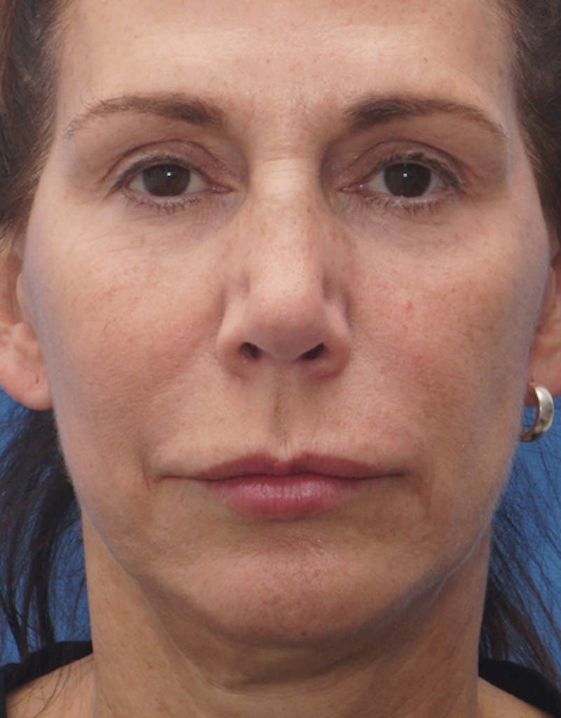 Chin Surgery Before & After Gallery - Patient 229983 - Image 9