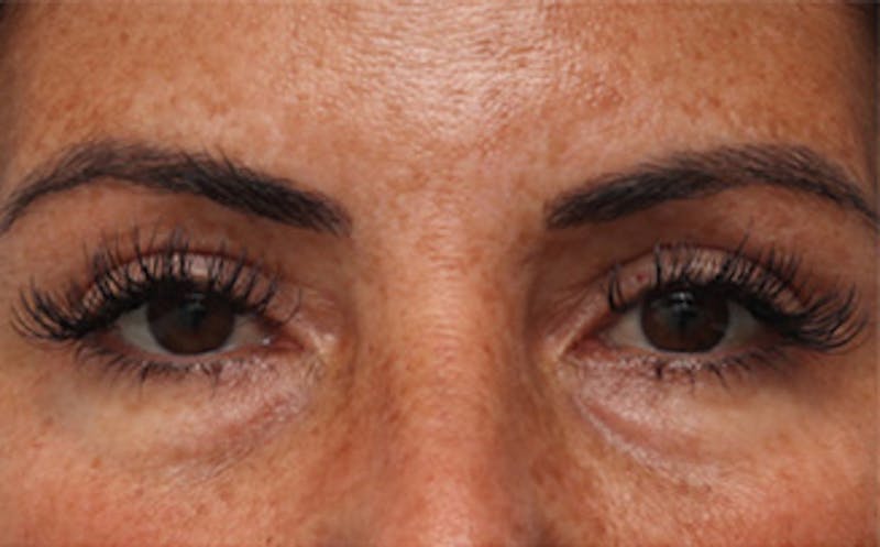 Eyelid Surgery Before & After Gallery - Patient 298444 - Image 2