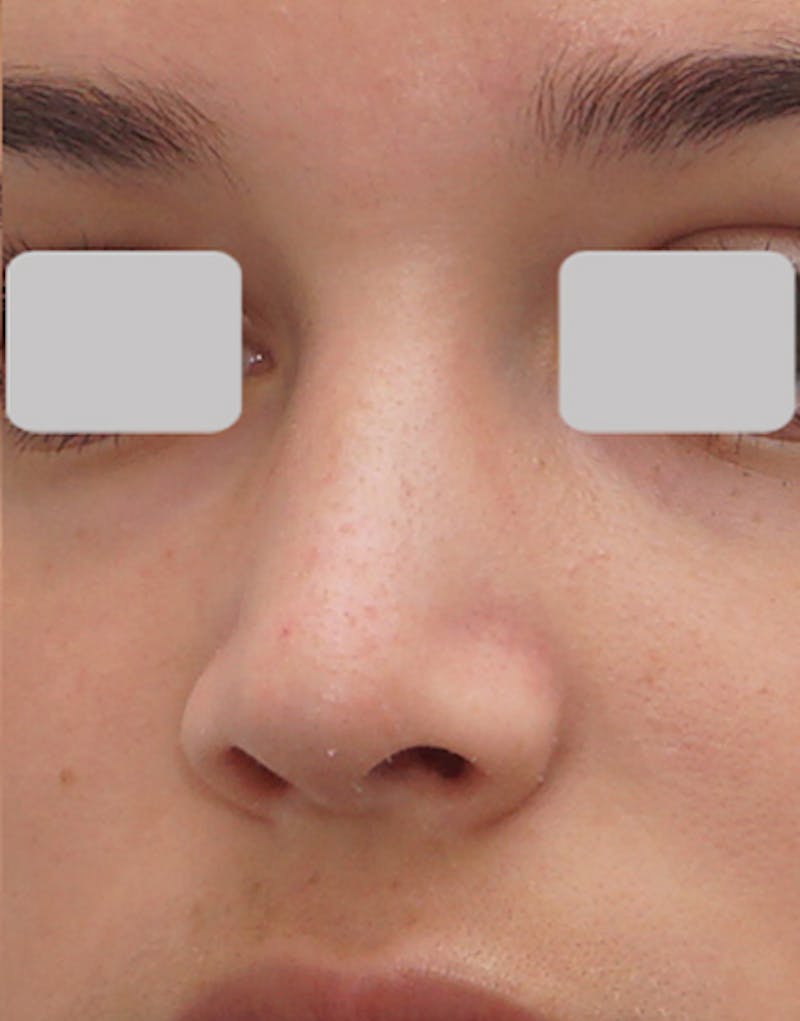 Rhinoplasty Before & After Gallery - Patient 125769 - Image 4