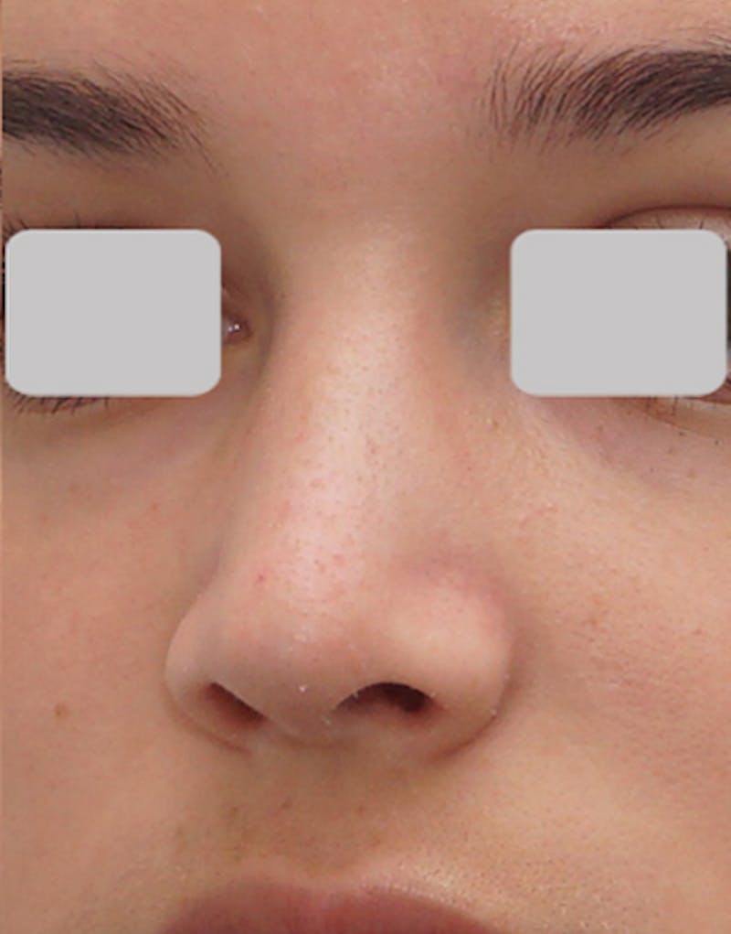 Rhinoplasty  Before & After Gallery - Patient 215853 - Image 4