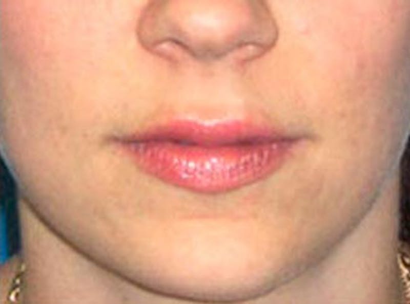 Lip Fillers Before & After Gallery - Patient 132953 - Image 2