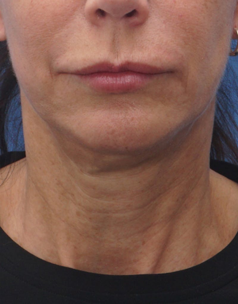 FaceTite Before & After Gallery - Patient 372280 - Image 1