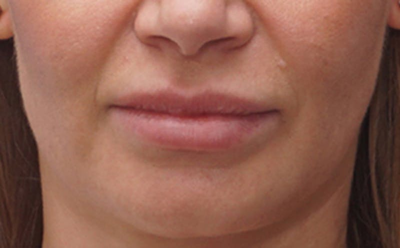 Fillers Before & After Gallery - Patient 290820 - Image 1