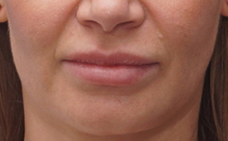 Patient LFu9eAveRsG_HesAqay9NA - Fillers Before & After Photos