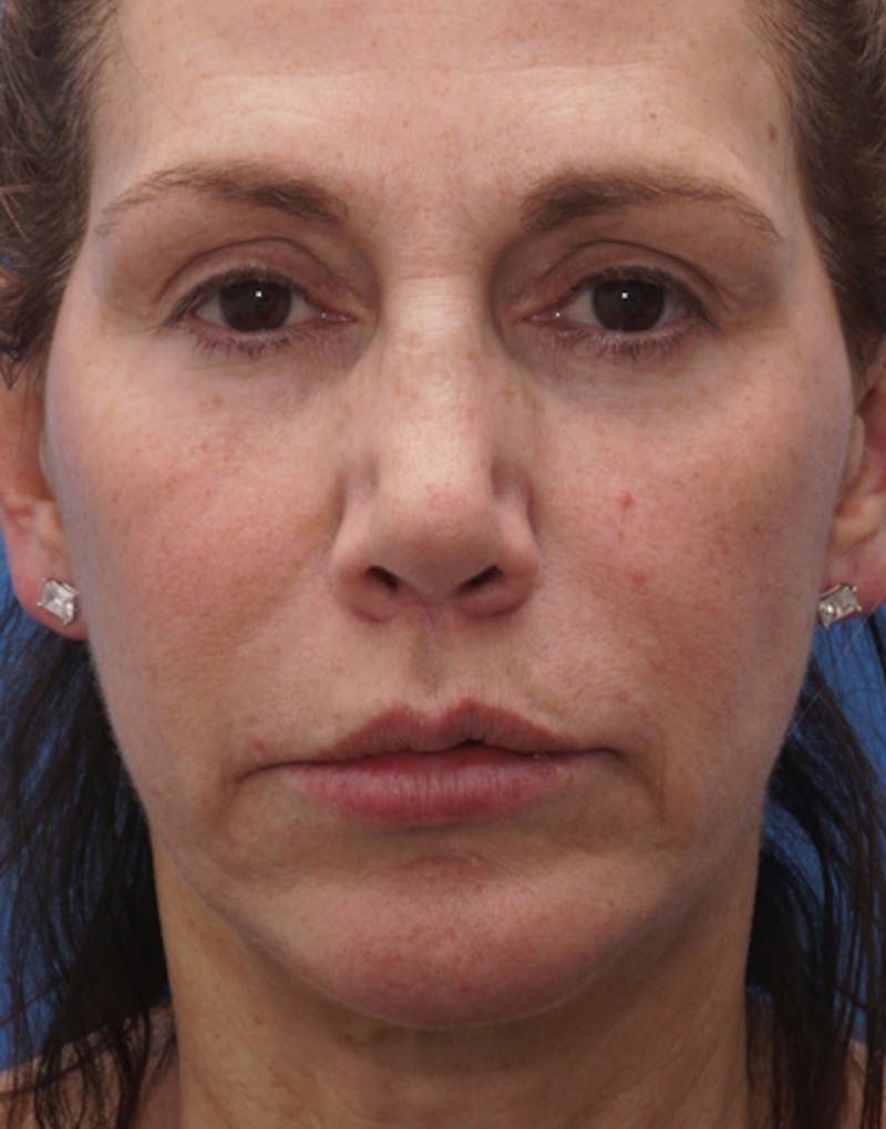 Chin Surgery Before & After Gallery - Patient 229983 - Image 10