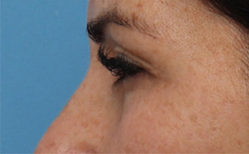 Eyelid Surgery Before & After Gallery - Patient 298444 - Image 7