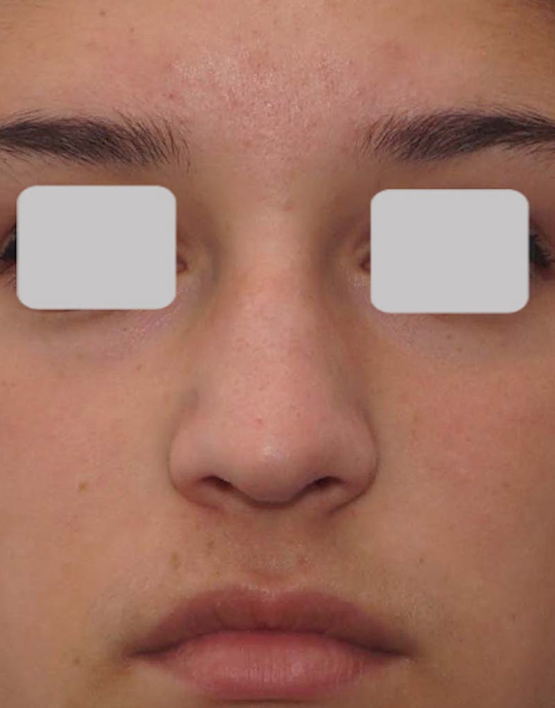 Rhinoplasty Before & After Gallery - Patient 125769 - Image 5