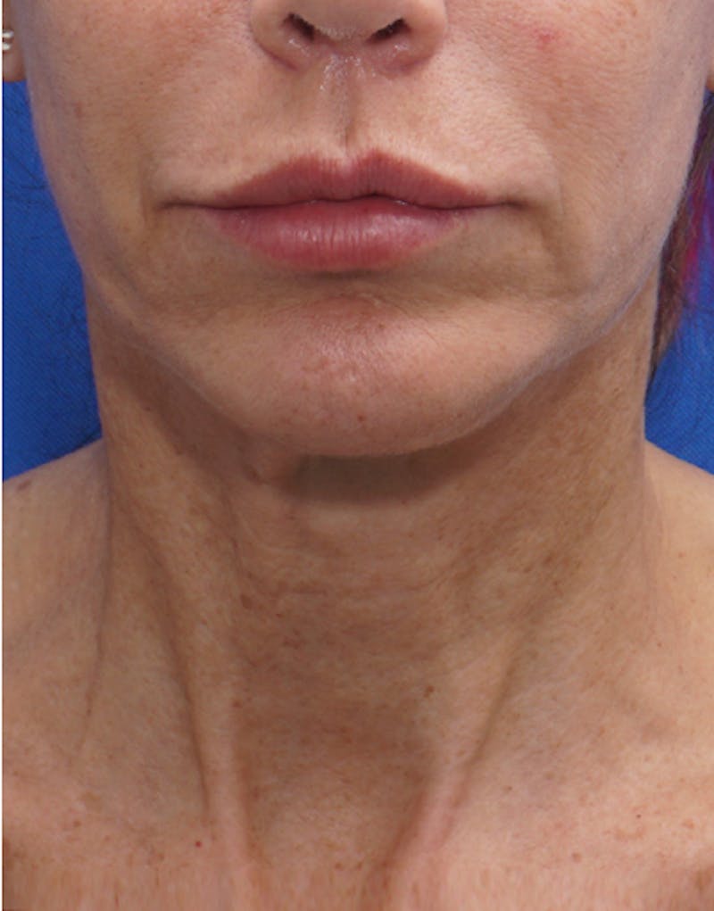 FaceTite Before & After Gallery - Patient 372280 - Image 2