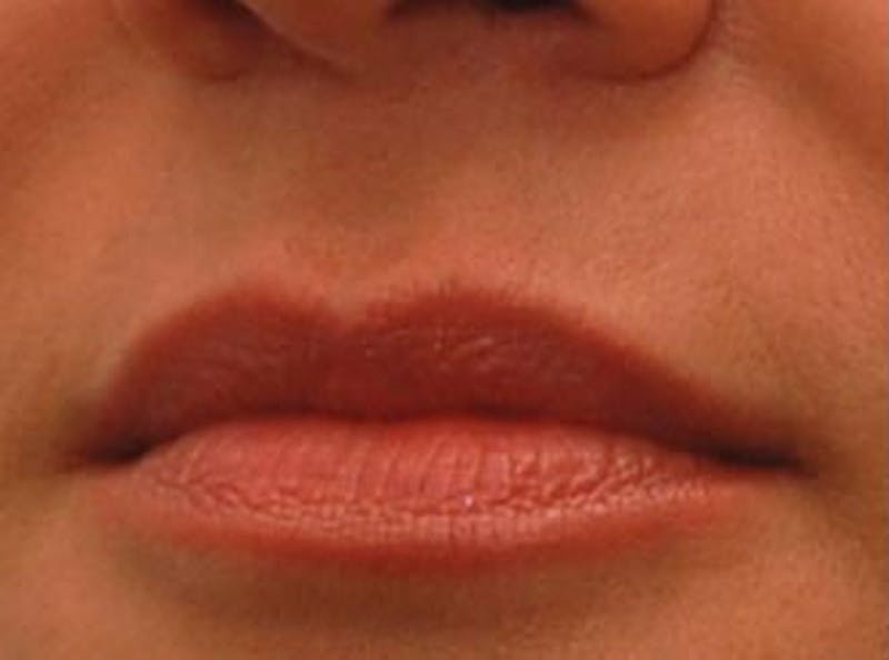 Lip Fillers Before & After Gallery - Patient 132953 - Image 3