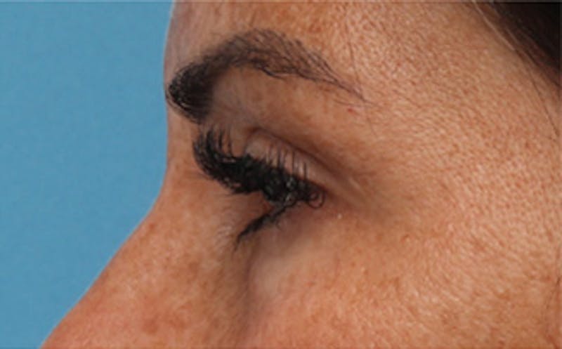 Eyelid Surgery Before & After Gallery - Patient 298444 - Image 8